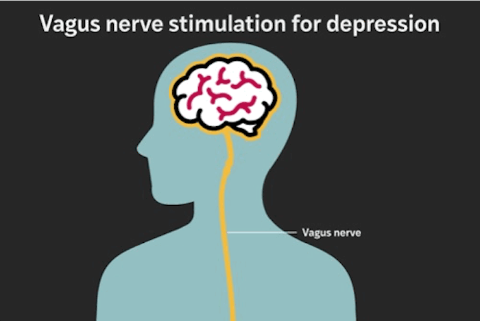 Implant Provides Lasting Relief for Treatment-Resistant Depression